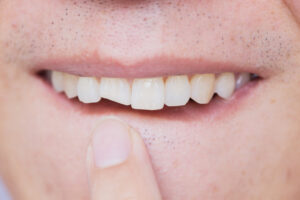 Male,Broken,Teeth,Damaged,Cracked,Front,Tooth,Need,Dentist,ToDental Emergency NW3 Male,Broken,Teeth,Damaged,Cracked,Front,Tooth,Need,Dentist,ToDental Emergency Dentist NW3