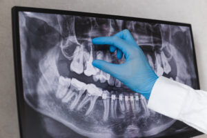 Doctor,Points,To,Filled,Root,Canal,In,Dental,X-ray Root canal radiograph