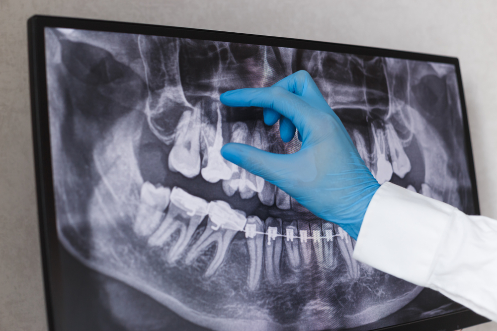Doctor,Points,To,Filled,Root,Canal,In,Dental,X-ray Root canal radiograph